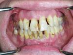 A smoker with severe periodontitis (gum disease)
Photo courtesy of: Dr Robert Hirsch