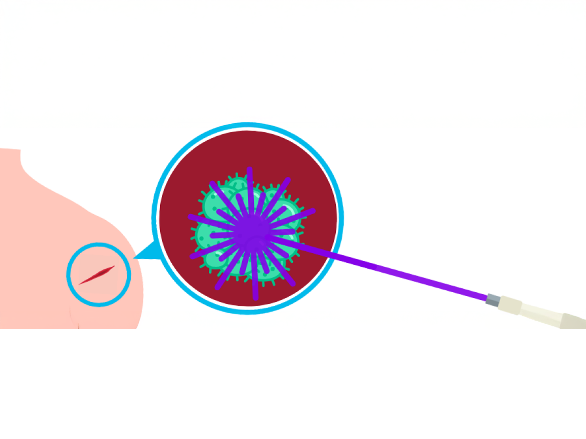 Wound image