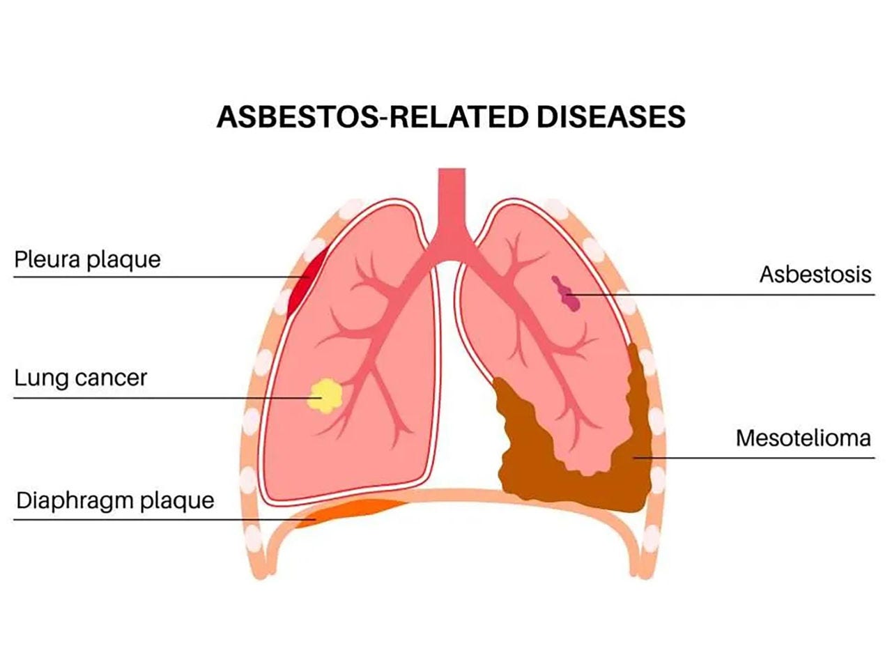 Asbestos-related diseases