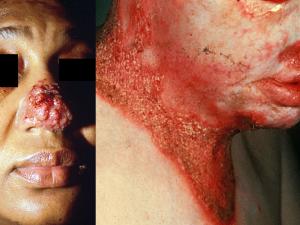 Ulcerated granuloma and cutaneous blastomycosis (Courtesy of John Rippon, USA).
