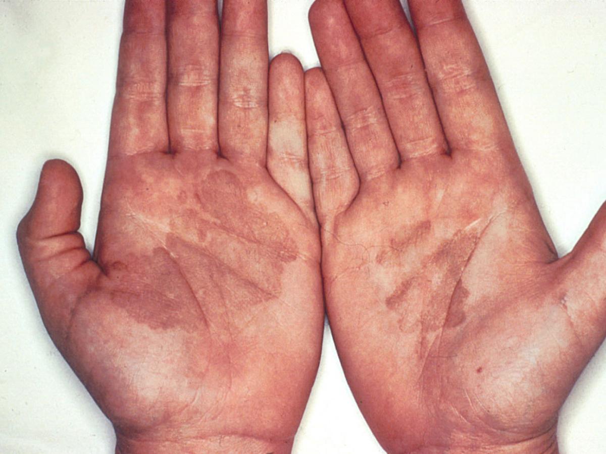 Unknown 22 clinical presentation