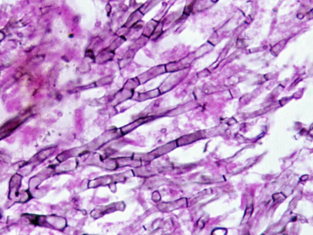 Direct microscopy (methenamine silver stain)