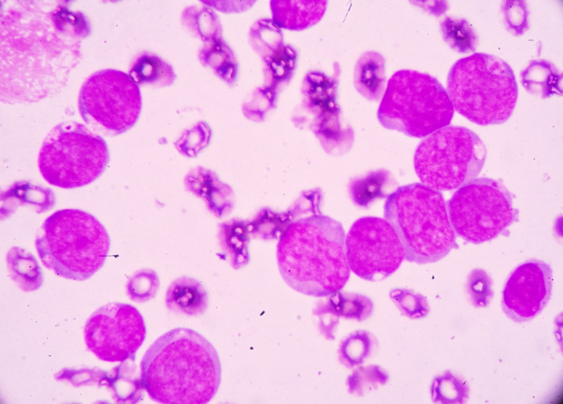 New therapy could help chronic myeloid leukemia patients live drug-free ...